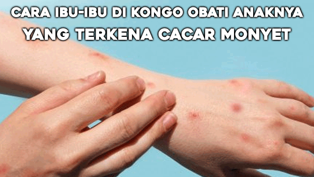 Cara Ibu-ibu di Kongo Obati Anaknya yang Terkena Cacar Monyet